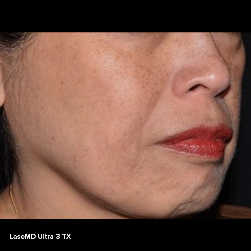 BA-LaserMD-After-01-3TX