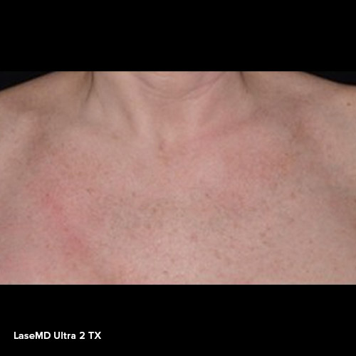 BA-LaserMD-After-02-2TX