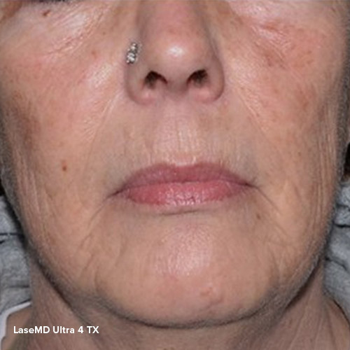 BA-LaserMD-After-03-4TX