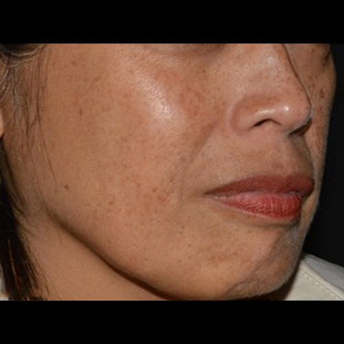 BA-LaserMD-Before-01