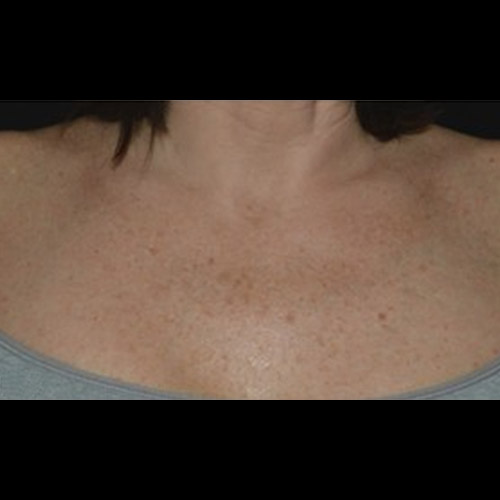 BA-LaserMD-Before-02