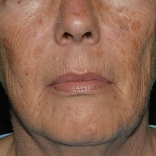 BA-LaserMD-Before-03