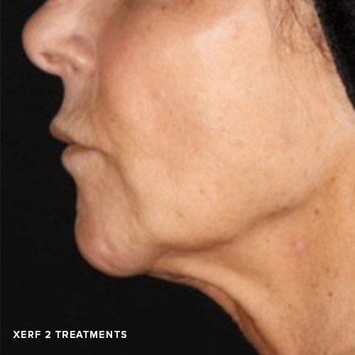 BA-XERF-After-01-2Treatments