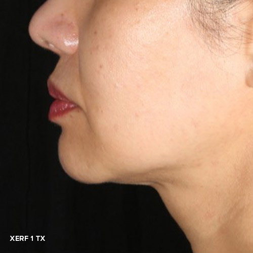BA-XERF-After-02-1Treatments